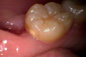 奥歯 審美歯科治療 ハイブリットセラミックスインレー 症例 30代 女性 N様 天王寺区在住