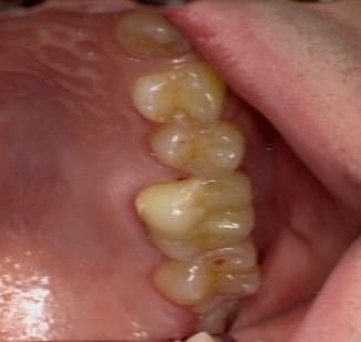 奥歯 審美歯科治療 ファイバーコア ジルコニアクラウン 症例 30代 男性 Y様 阿倍野区在住
