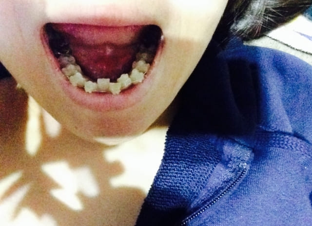 子供の歯並び