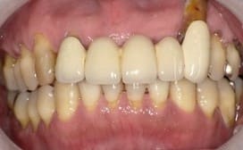 前歯 抜歯即時インプラント埋入症例 50代 男性 Y様 阿倍野区在住