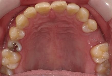 奥歯 インプラント治療 症例 30代 男性 T様 阿倍野区在住