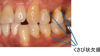 くさび状欠損の歯