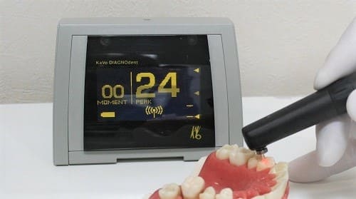 虫歯の数値化