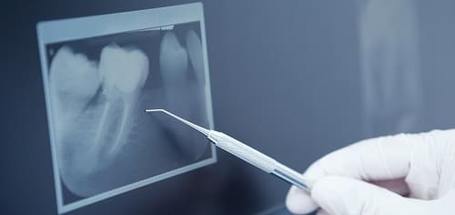 虫歯のレントゲン検査