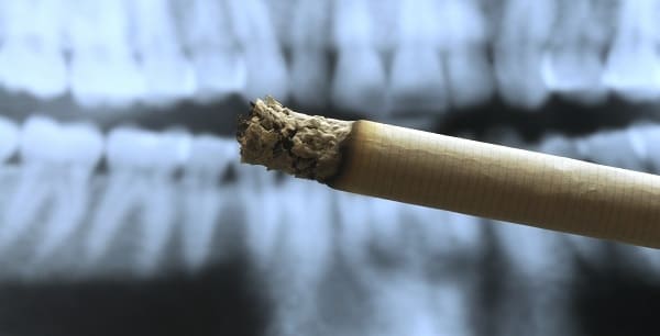 喫煙（タバコ）と歯と歯茎のレントゲン