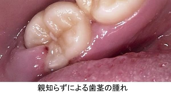親知らずによる歯茎の腫れ