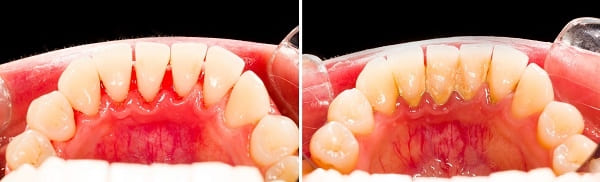 歯石が付いていない歯と付いた歯の比較