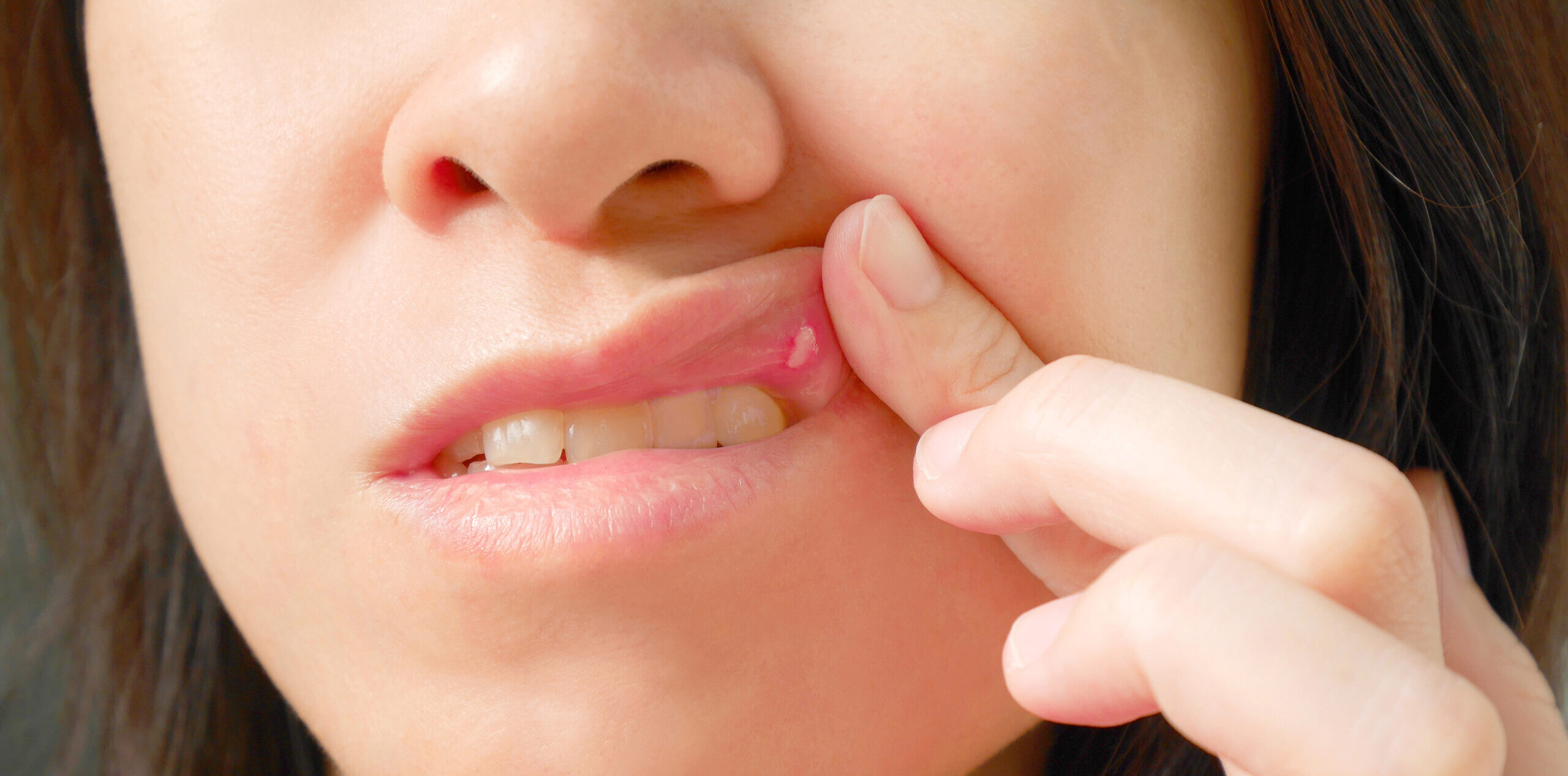 口内炎の早い治し方と予防！