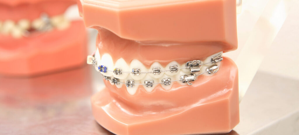 歯列　矯正治療　保険が適用されない　理由