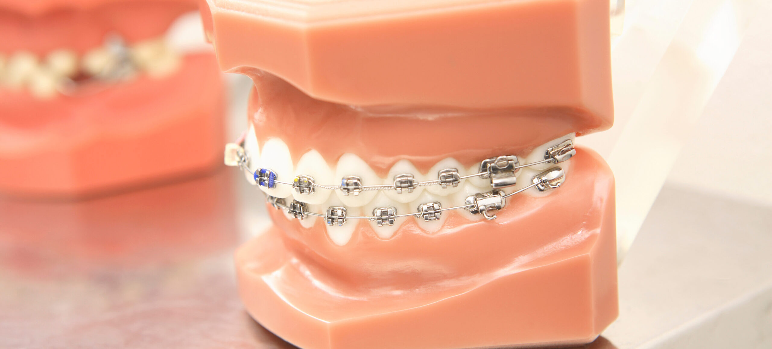 歯列の矯正治療に保険が適用されない理由