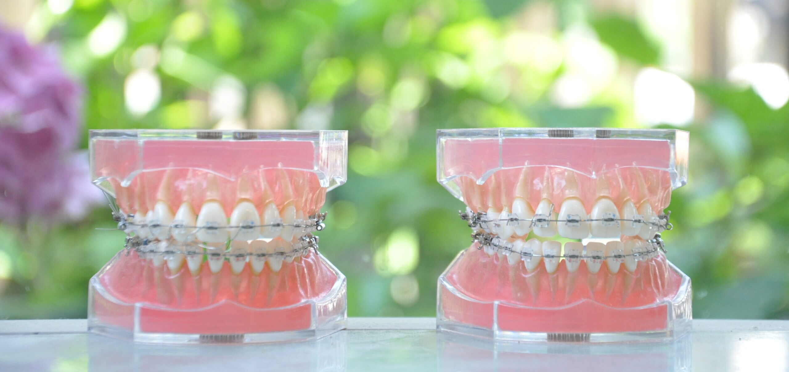 矯正歯科の治療と種類を紹介
