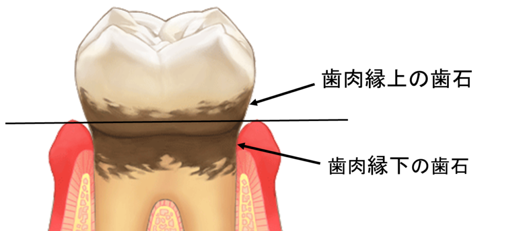 阿倍野区　歯医者　歯肉　縁上歯石　縁下歯石