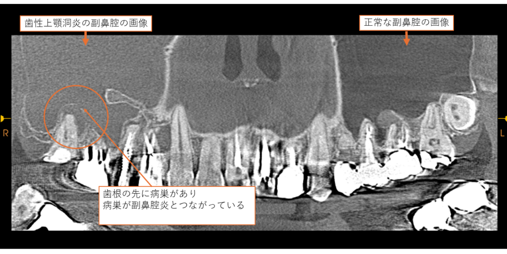 歯性上顎洞炎　副鼻腔炎　西田辺えがしら歯科