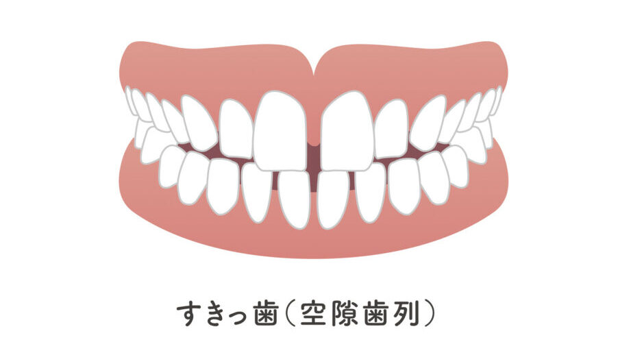 すきっ歯の治療法について