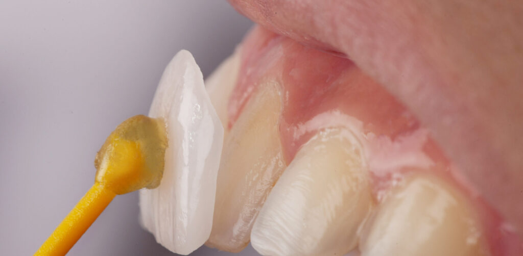 阿倍野区　歯の欠け　歯　ラミネートベニア