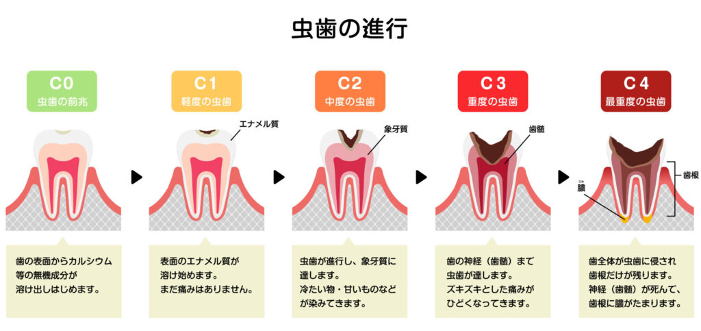 虫歯を確かめる方法（セルフチェック）と虫歯を見つけた時の対策について | 西田辺(阿倍野区)の歯医者 歯周病｜西田辺えがしら歯科