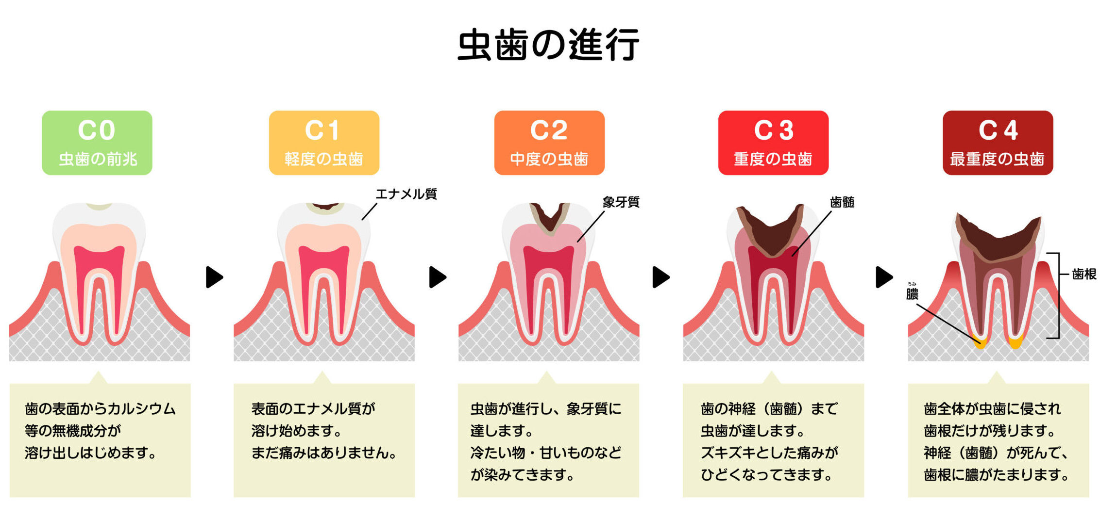虫歯を確かめる方法（セルフチェック）と虫歯を見つけた時の対策について