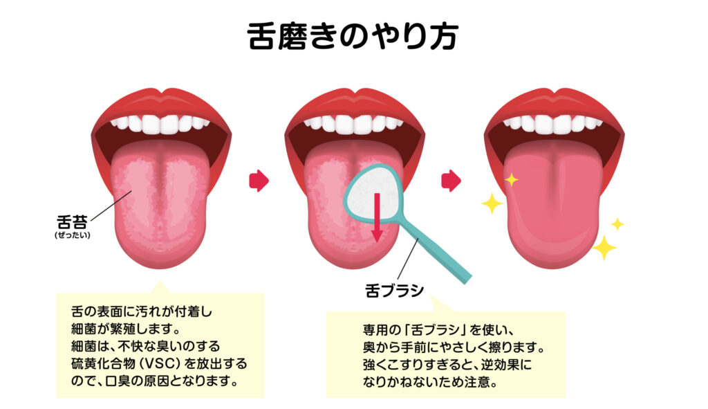 阿倍野区　舌磨き　やり方　歯医者