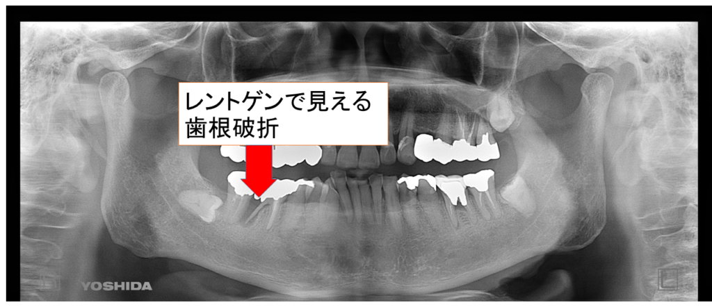 阿倍野区　歯根破折　パノラマレントゲン写真