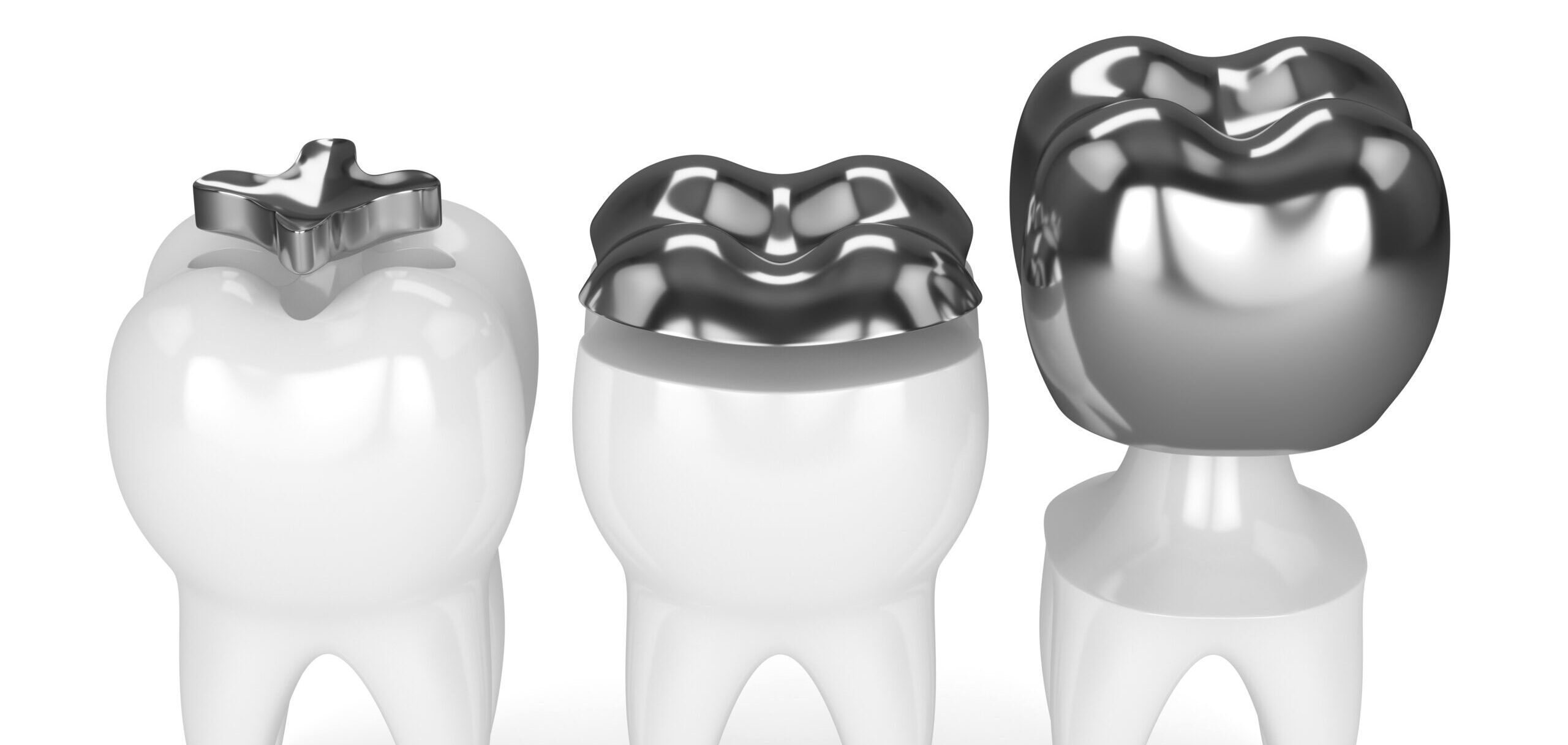 歯科治療で使われる金属の種類や特徴を解説