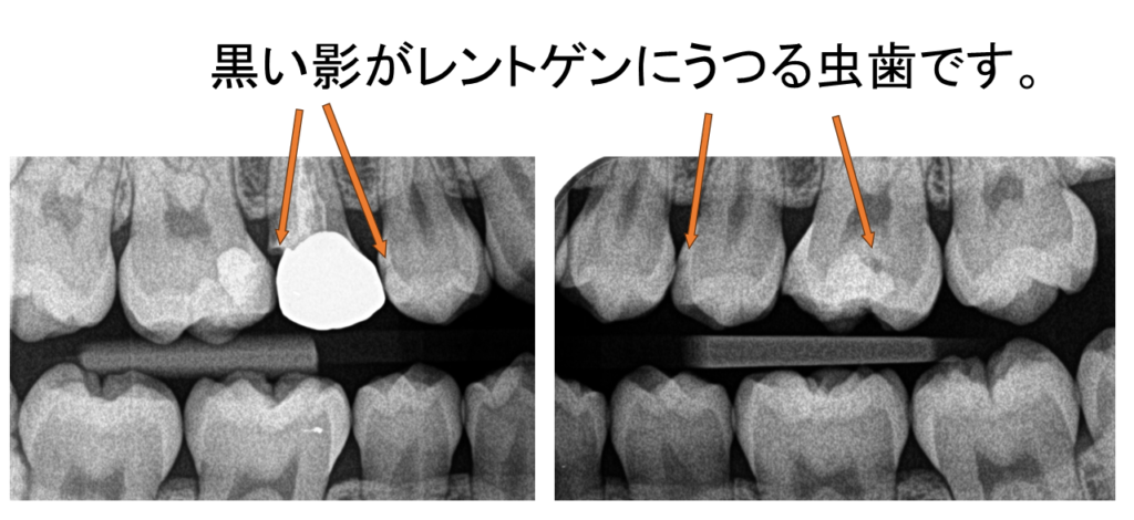 阿倍野区　レントゲン　虫歯　画像　１