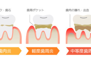 阿倍野区　西田辺　歯科　歯医者　西田辺えがしら歯科　歯がグラグラ　原因