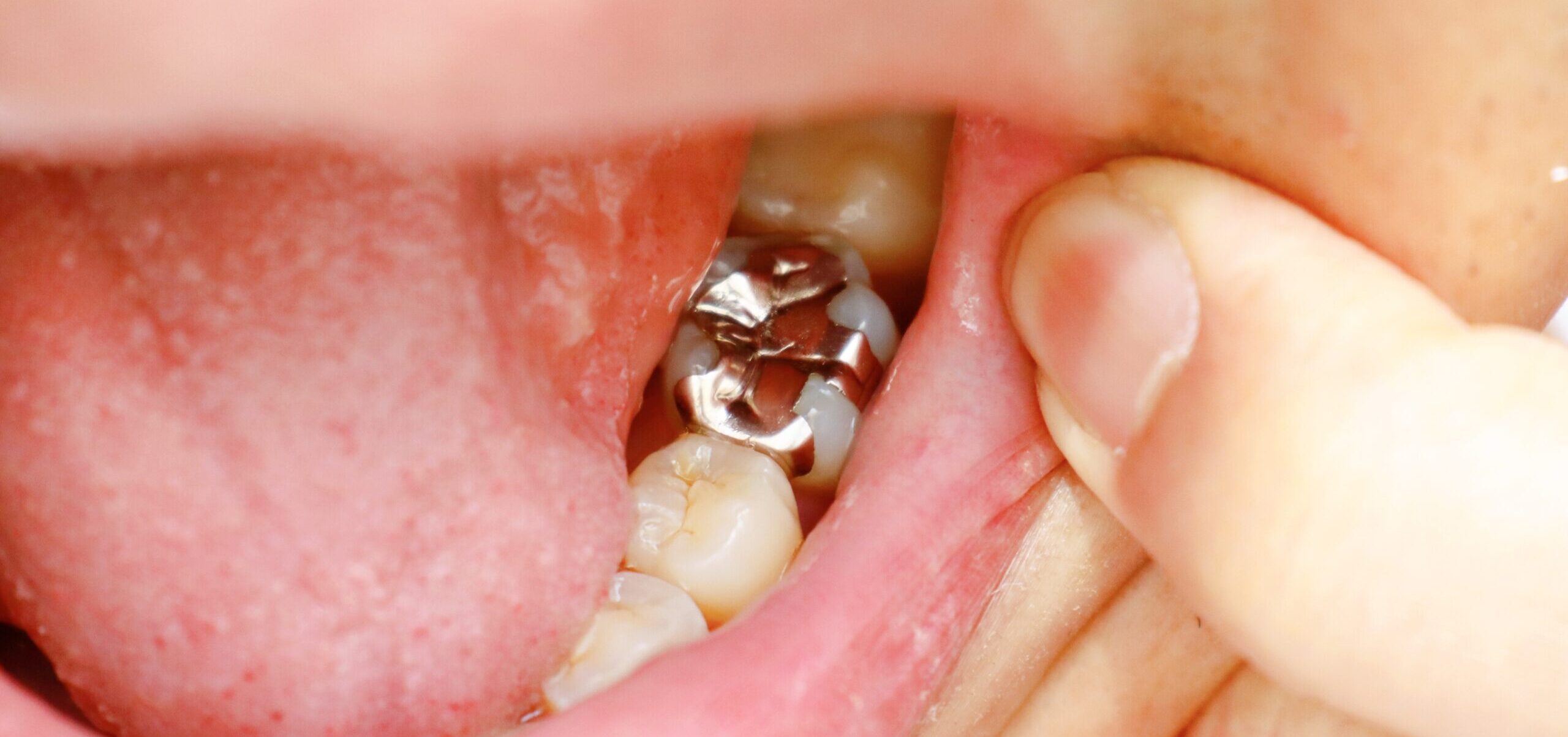 銀歯の中が虫歯になる理由