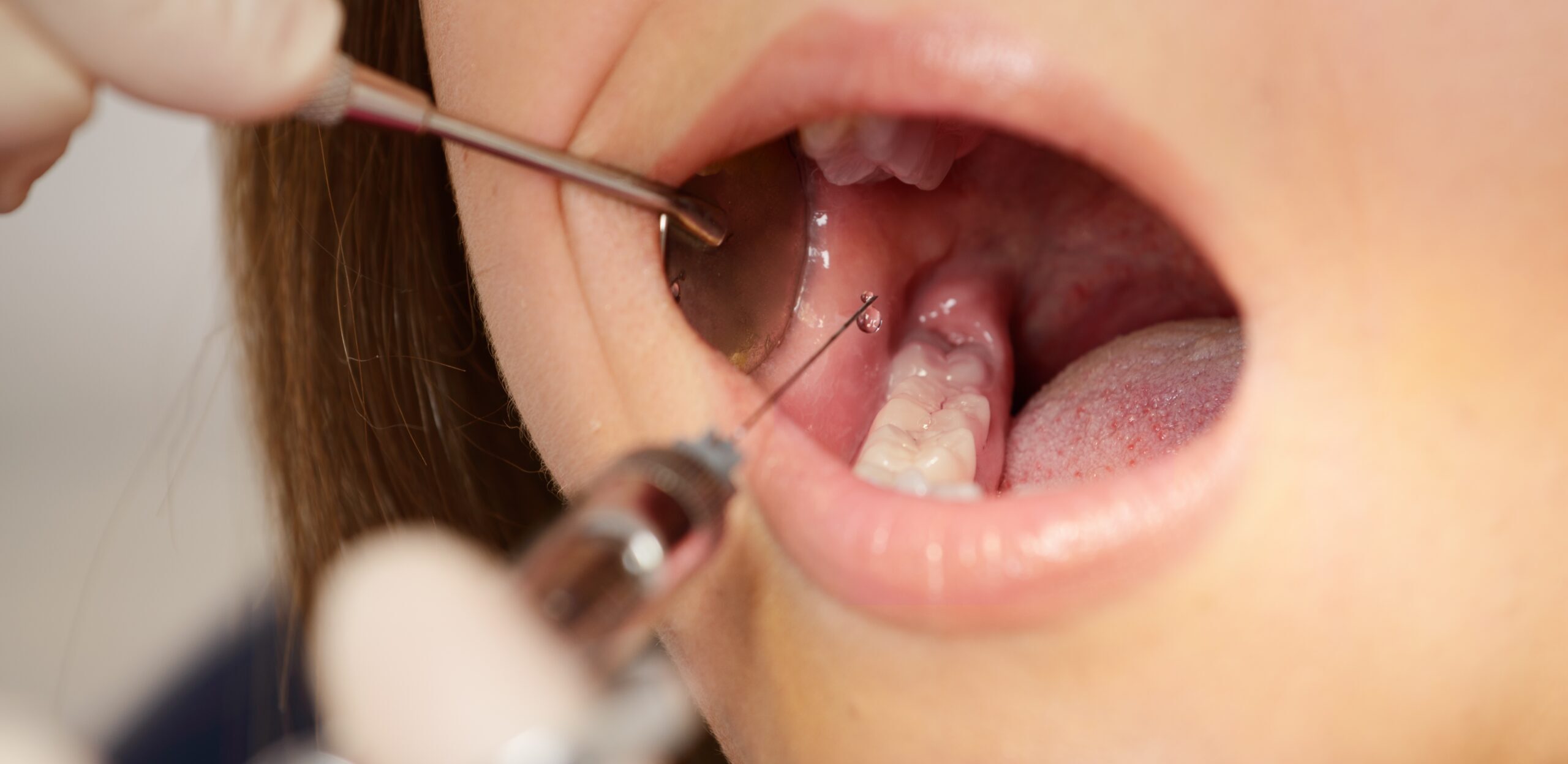 歯の麻酔に関するQ&A