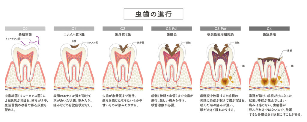 阿倍野区　歯医者　西田辺えがしら歯科　虫歯　放置