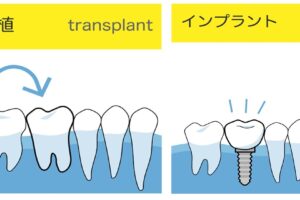阿倍野区　西田辺　歯医者　歯科　西田辺えがしら歯科　インプラント　歯の移植