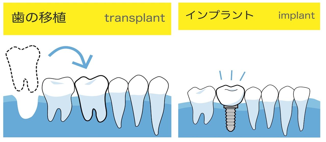 歯の移植とインプラントはどっちがいい？
