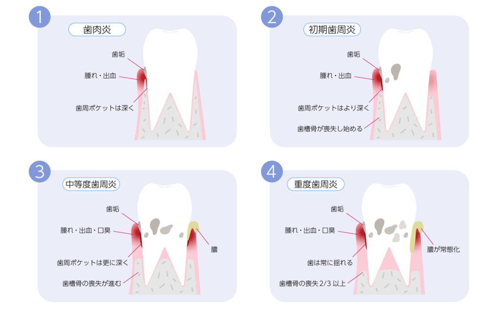 歯周病の進行　阿倍野区　歯医者　西田辺えがしら歯科