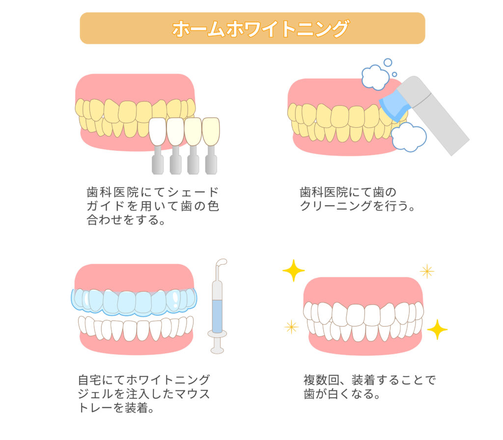 ホームホワイトニング　歯医者　西田辺えがしら歯科　歯