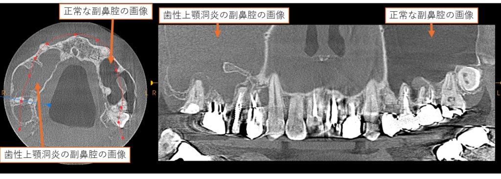 歯性上顎洞炎 阿倍野区 西田辺えがしら歯科 副鼻腔炎 歯医者