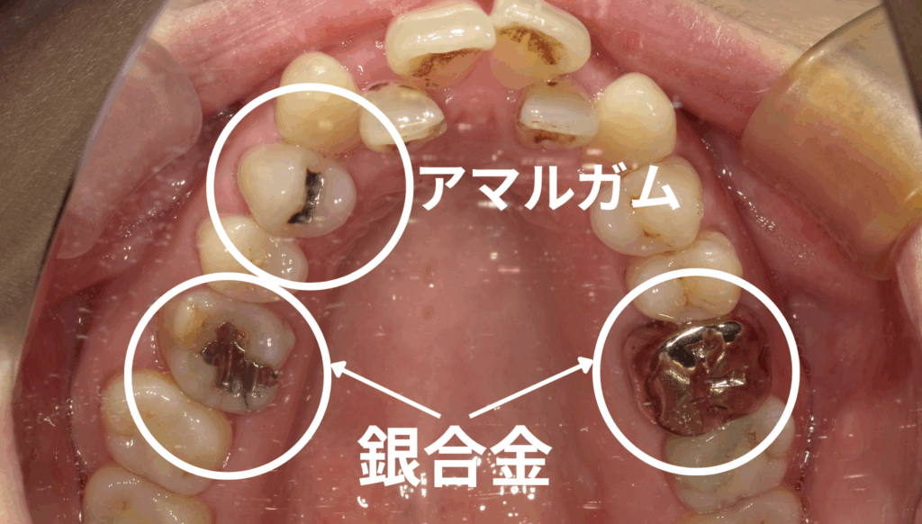アマルガム　歯医者　見分け方　阿倍野区　西田辺えがしら歯科