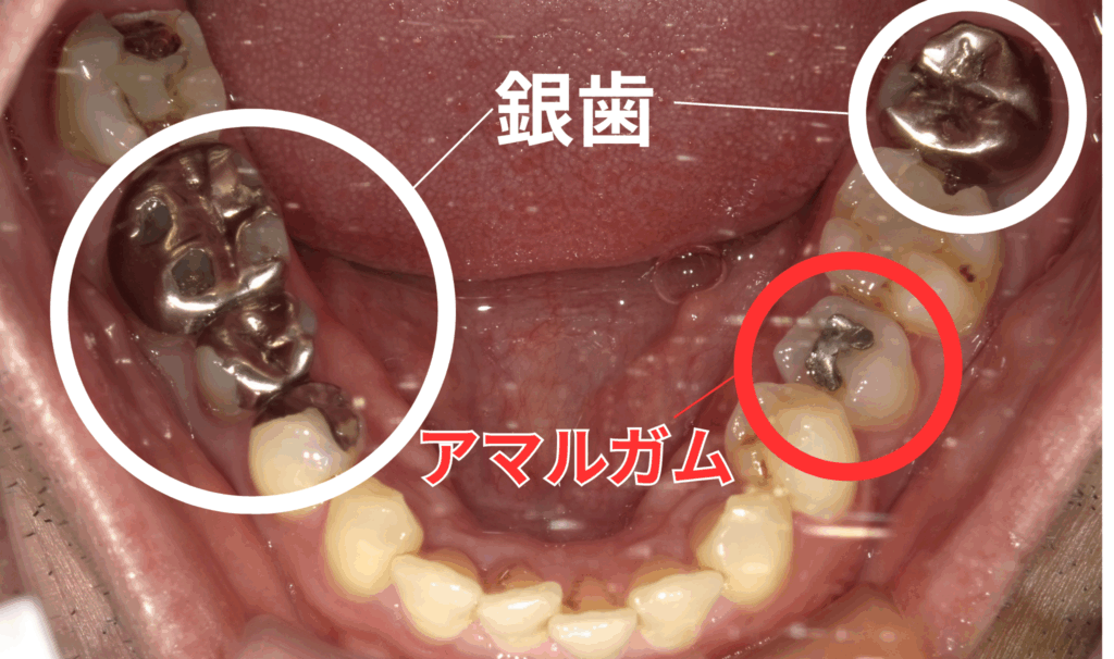 アマルガム　歯医者　阿倍野区　西田辺えがしら歯科