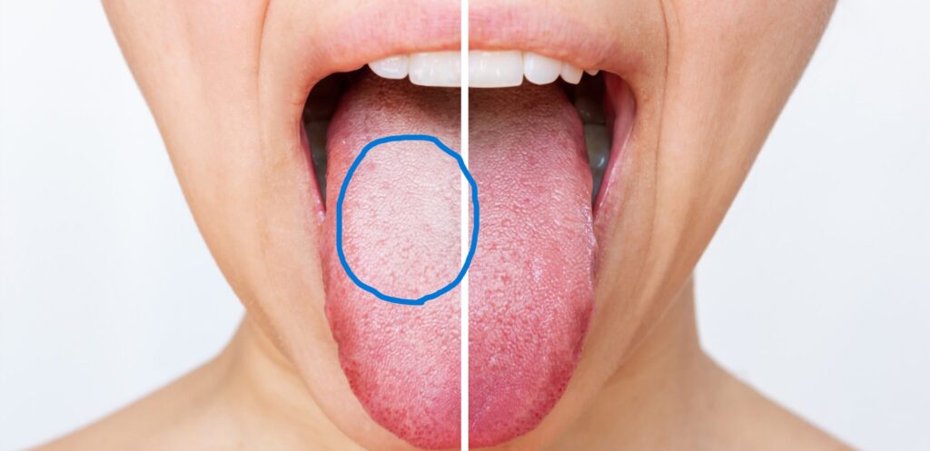 臭舌　汚れ　口臭　治療　原因　対策　西田辺えがしら歯科　阿倍野区　歯医者　