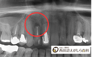 根尖性歯周炎　治療　症状　虫歯　歯性上顎洞炎　根管治療　西田辺えがしら歯科　阿倍野区　歯医者