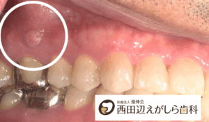 根尖性歯周炎　治療　症状　虫歯　歯性上顎洞炎　根管治療　西田辺えがしら歯科　阿倍野区　歯医者 
