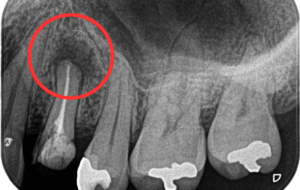 根尖性歯周炎　治療　症状　虫歯　歯性上顎洞炎　根管治療　西田辺えがしら歯科　阿倍野区　歯医者