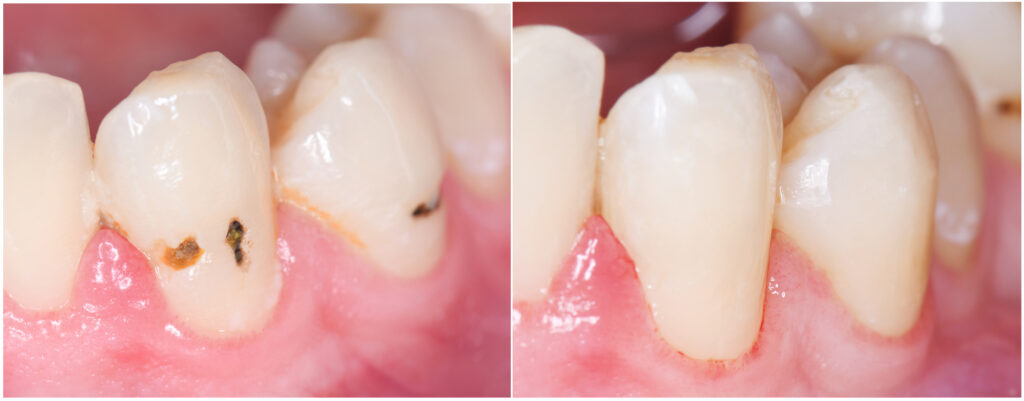 コンポジットレジン 大丈夫 歯医者 阿倍野区 西田辺えがしら歯科