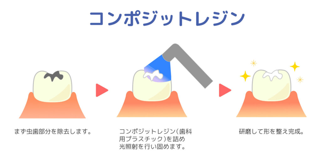 コンポジットレジン 大丈夫 歯医者 阿倍野区 西田辺えがしら歯科