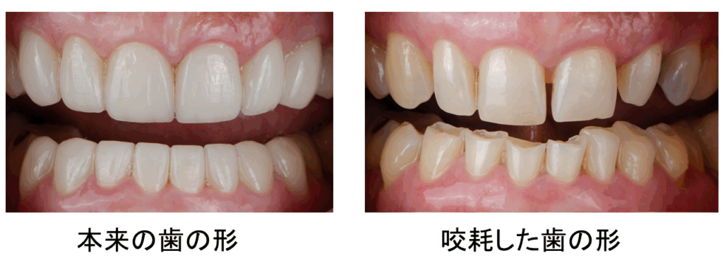 歯 咬耗 治療 阿倍野区 歯医者 西田辺えがしら歯科