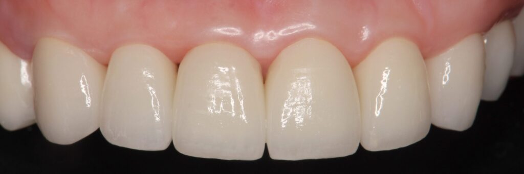 歯 咬耗 治療 阿倍野区 歯医者 西田辺えがしら歯科