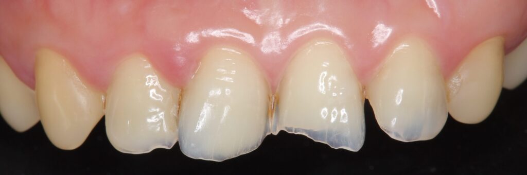 歯 咬耗 治療 阿倍野区 歯医者 西田辺えがしら歯科