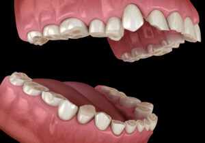 歯 咬耗 治療 阿倍野区 歯医者 西田辺えがしら歯科