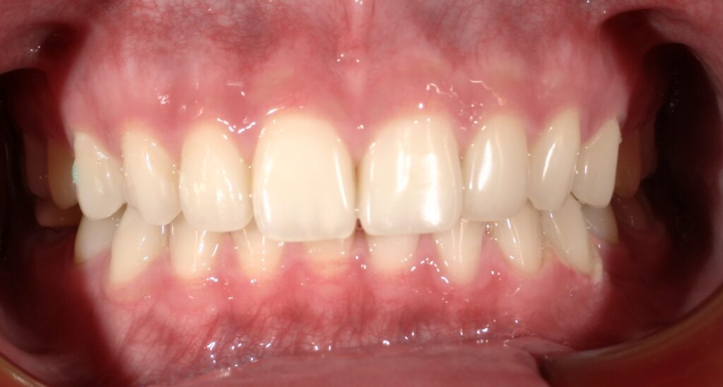 歯 ホワイトニング 術後 西田辺えがしら歯科