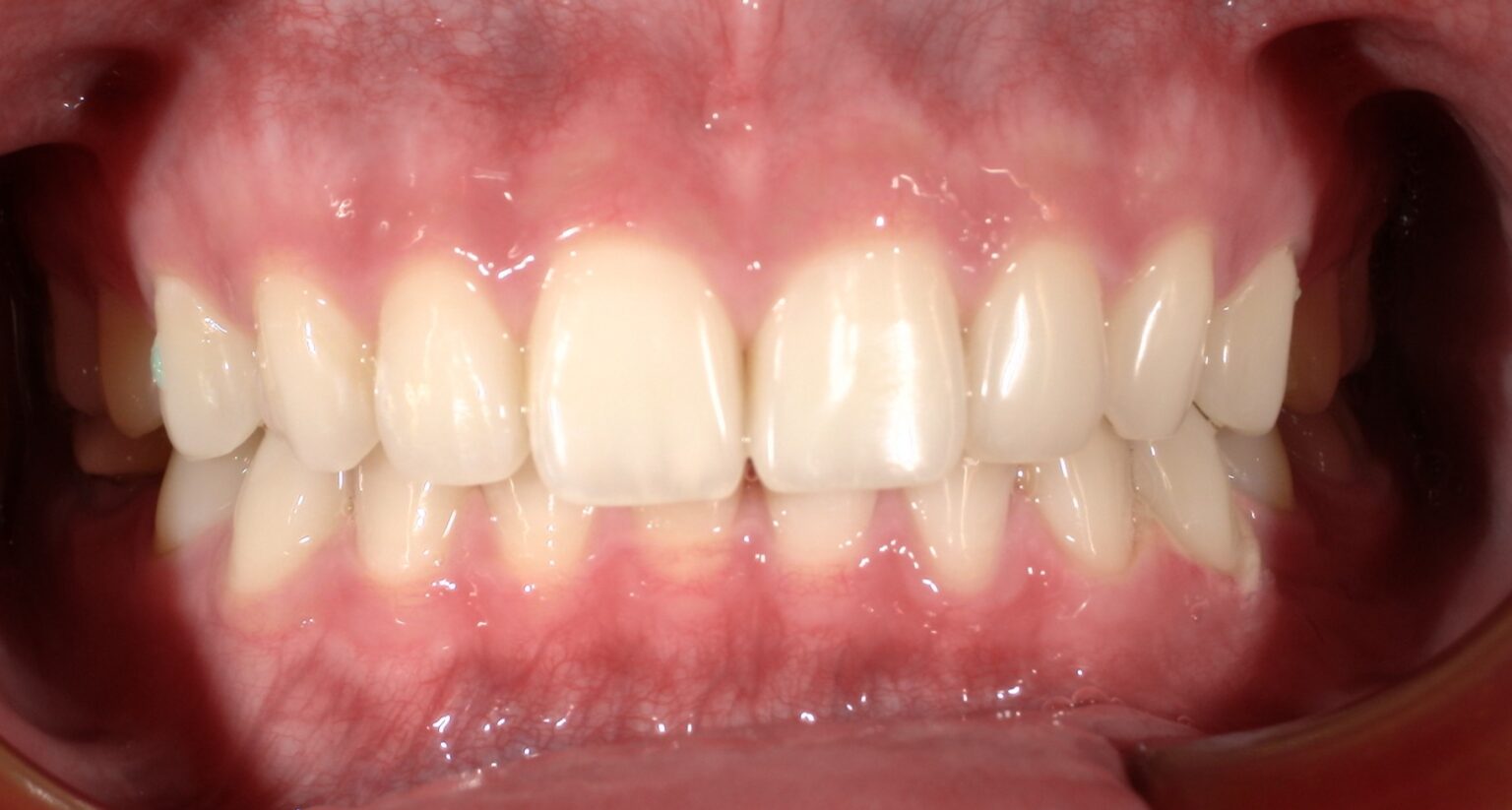 歯　ホワイトニング　術後　西田辺えがしら歯科