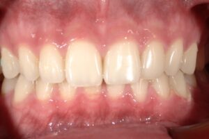 歯　ホワイトニング　術後　西田辺えがしら歯科