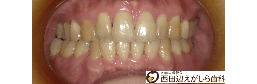 ホワイトニング　歯　術前　西田辺えがしら歯科